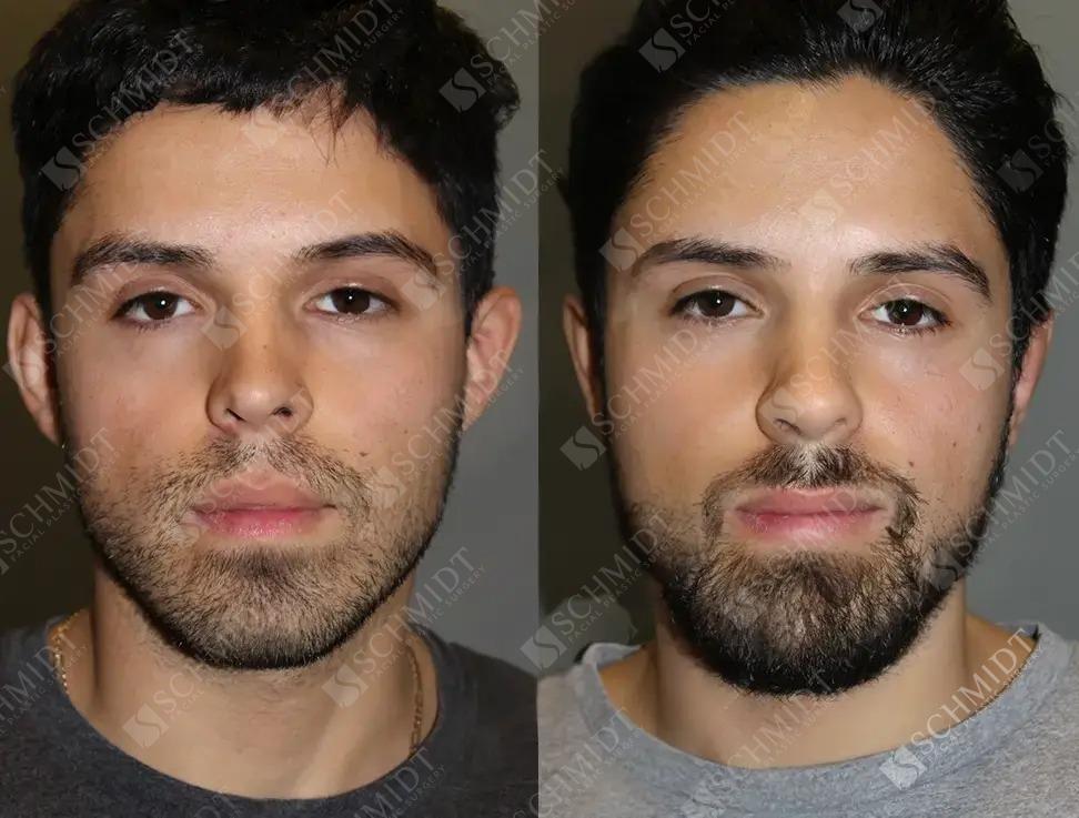 Schmidt Plastic Surgery otoplasty result — Englewood, CO