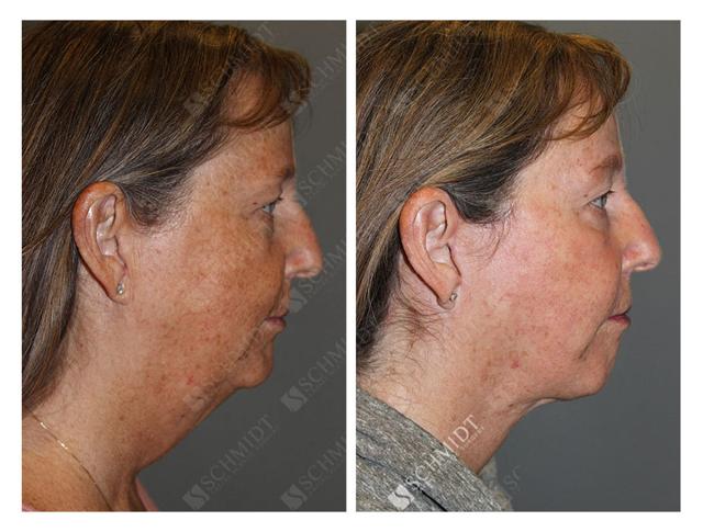 Facelift result at Schmidt Plastic Surgery in Englewood, CO