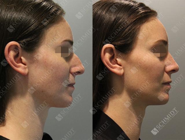 Rhinoplasty result at Schmidt Plastic Surgery in Englewood, CO