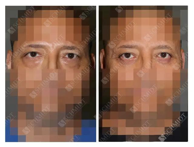 Blepharoplasty result at Schmidt Plastic Surgery in Englewood, CO