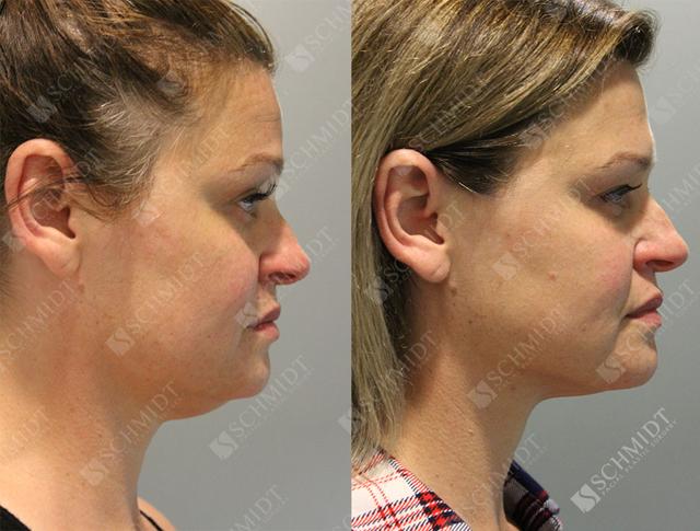 Liposuction result at Schmidt Plastic Surgery in Englewood, CO