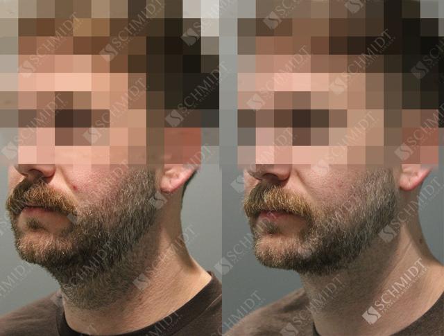 Neck Liposuction result at Schmidt Plastic Surgery in Englewood, CO