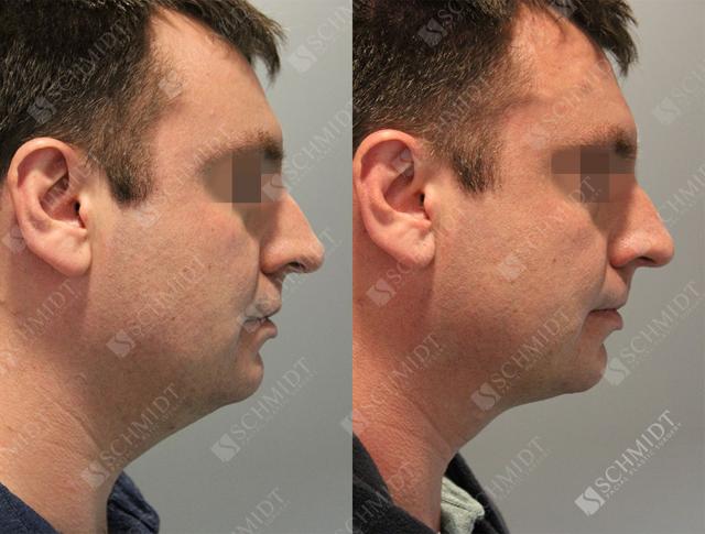 Neck Liposuction result at Schmidt Plastic Surgery in Englewood, CO