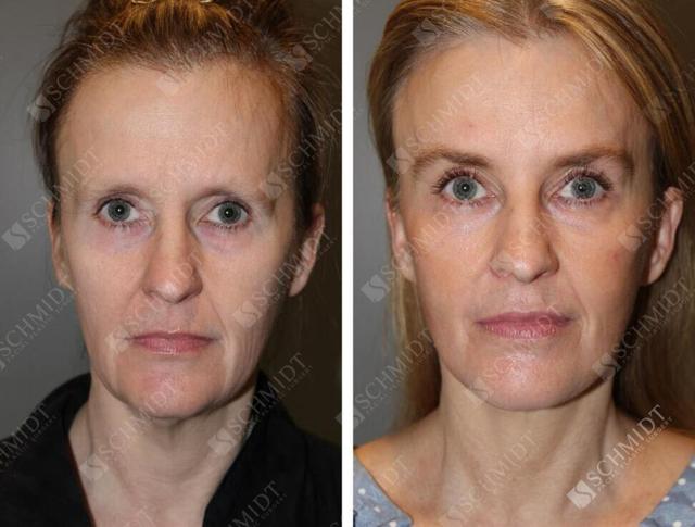Brow Lift result at Schmidt Plastic Surgery in Englewood, CO