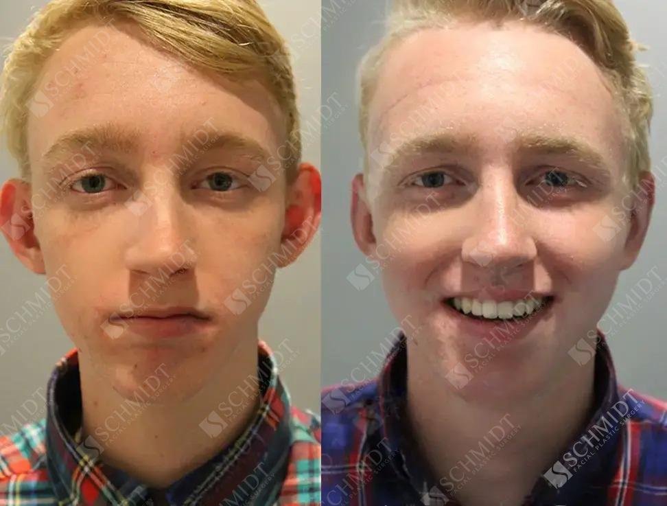 Schmidt Plastic Surgery otoplasty result — Englewood, CO