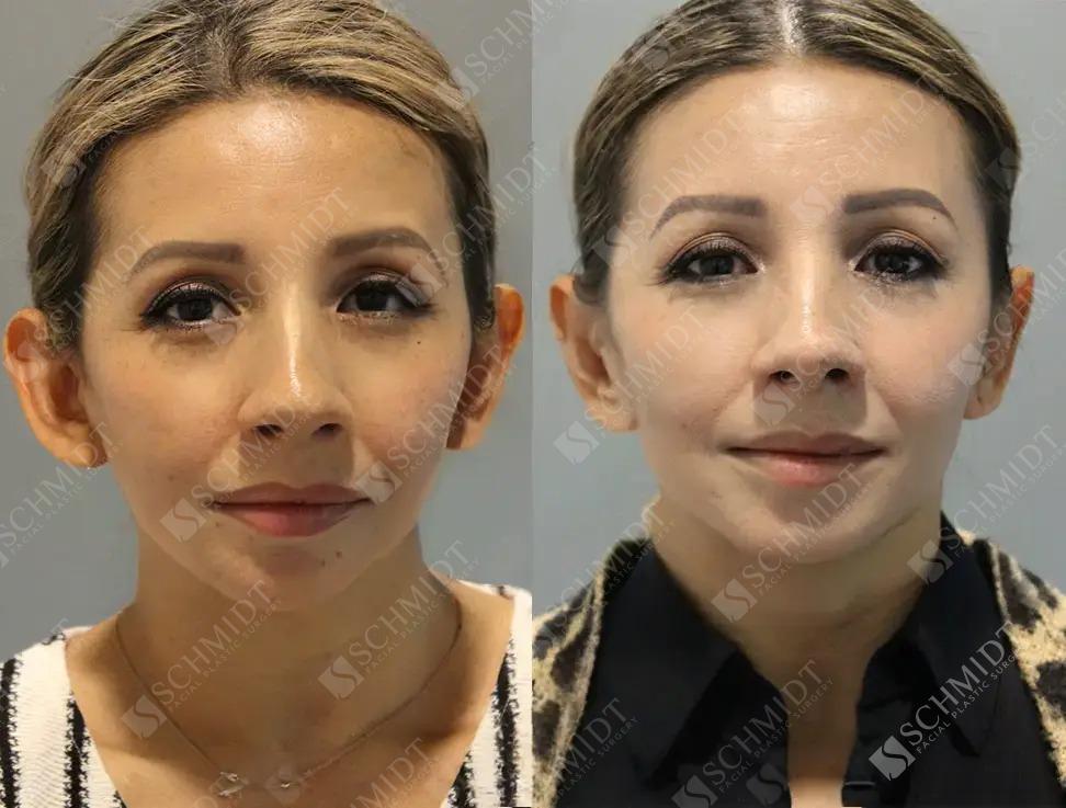 Schmidt Plastic Surgery otoplasty result — Englewood, CO