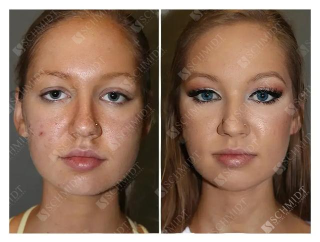 Chin Implant result at Schmidt Plastic Surgery in Englewood, CO