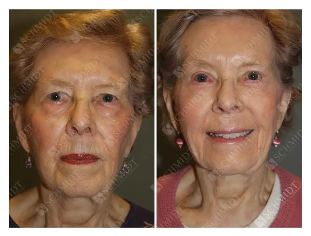 Blepharoplasty result at Schmidt Plastic Surgery in Englewood, CO