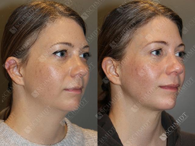 Neck Liposuction result at Schmidt Plastic Surgery in Englewood, CO