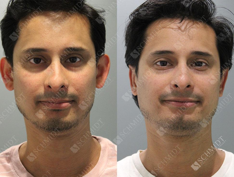 Schmidt Plastic Surgery otoplasty result — Englewood, CO