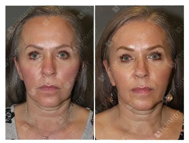 Brow Lift result at Schmidt Plastic Surgery in Englewood, CO