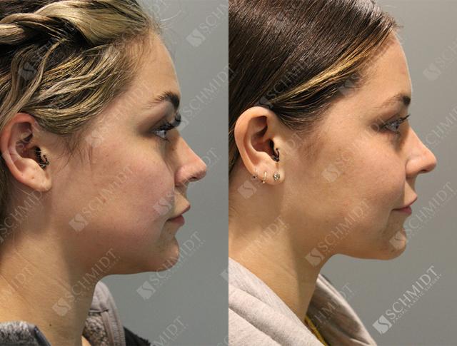 Neck Liposuction result at Schmidt Plastic Surgery in Englewood, CO