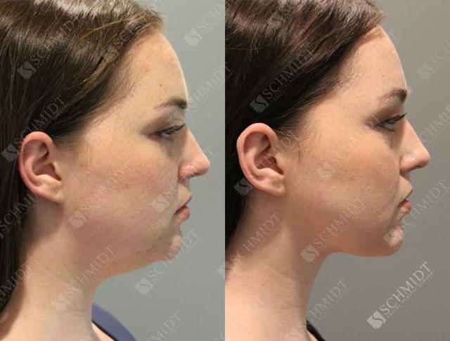 Neck Liposuction result at Schmidt Plastic Surgery in Englewood, CO