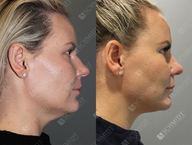 Liposuction result at Schmidt Plastic Surgery in Englewood, CO