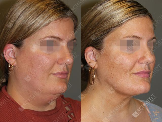 Liposuction result at Schmidt Plastic Surgery in Englewood, CO