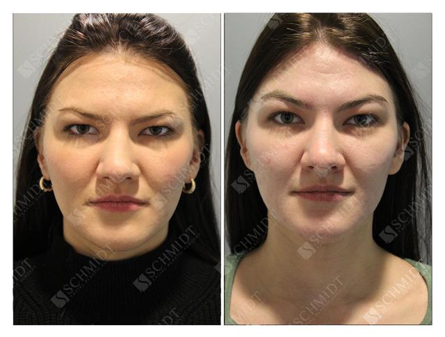 Brow Lift result at Schmidt Plastic Surgery in Englewood, CO