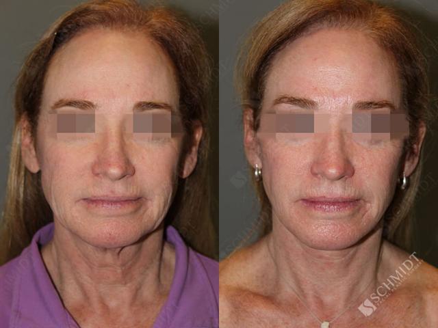 Neck Lift result at Schmidt Plastic Surgery in Englewood, CO