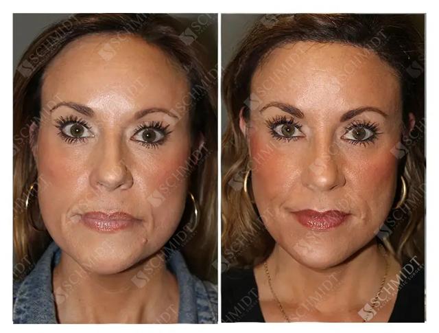 Deep Plane Facelift result at Schmidt Plastic Surgery in Englewood, CO