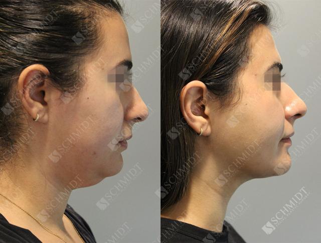 Neck Liposuction result at Schmidt Plastic Surgery in Englewood, CO