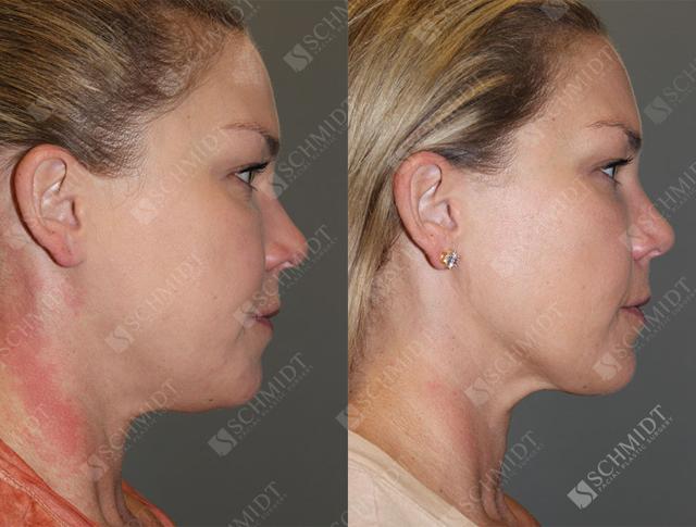 Neck Liposuction result at Schmidt Plastic Surgery in Englewood, CO