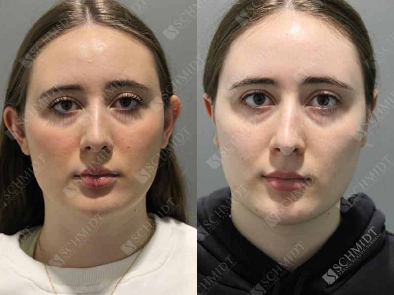 Schmidt Plastic Surgery otoplasty result — Englewood, CO