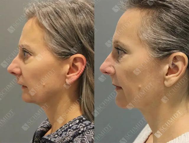 Chin Implant result at Schmidt Plastic Surgery in Englewood, CO