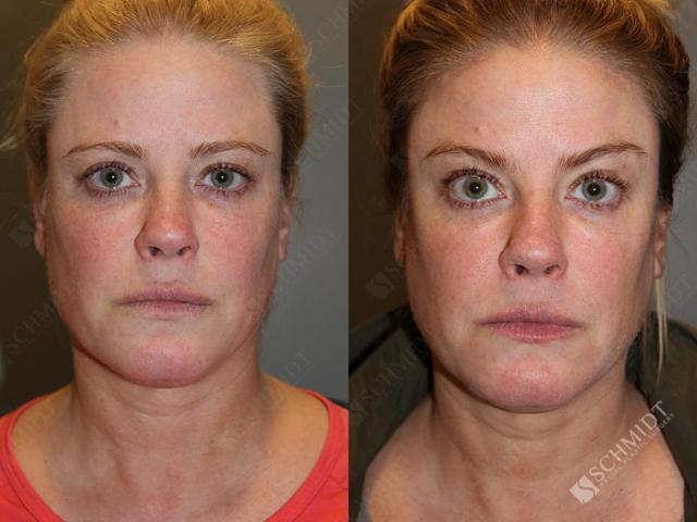 Brow Lift result at Schmidt Plastic Surgery in Englewood, CO