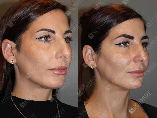 Rhinoplasty result at Schmidt Plastic Surgery in Englewood, CO