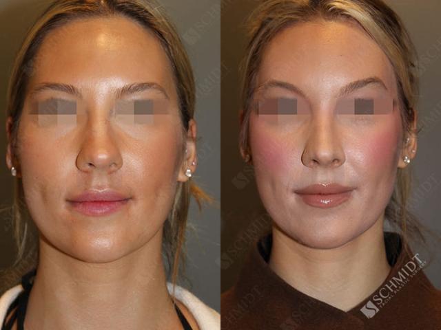 Brow Lift result at Schmidt Plastic Surgery in Englewood, CO