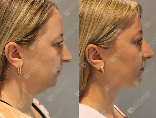 Chin Implant result at Schmidt Plastic Surgery in Englewood, CO
