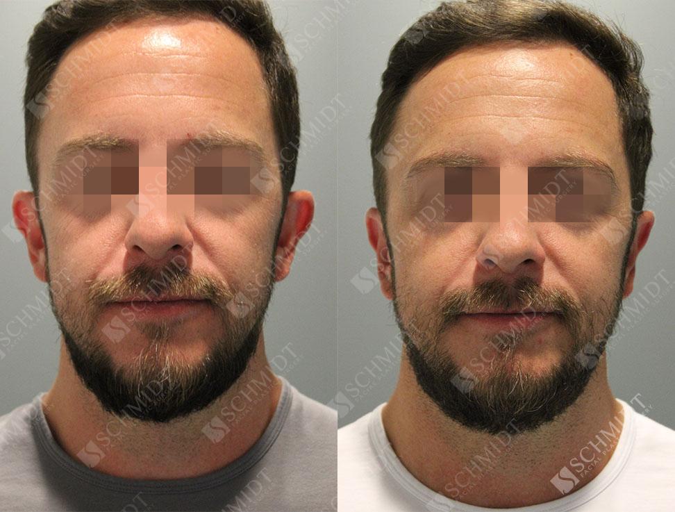 Schmidt Plastic Surgery otoplasty result — Englewood, CO