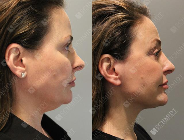 Liposuction result at Schmidt Plastic Surgery in Englewood, CO