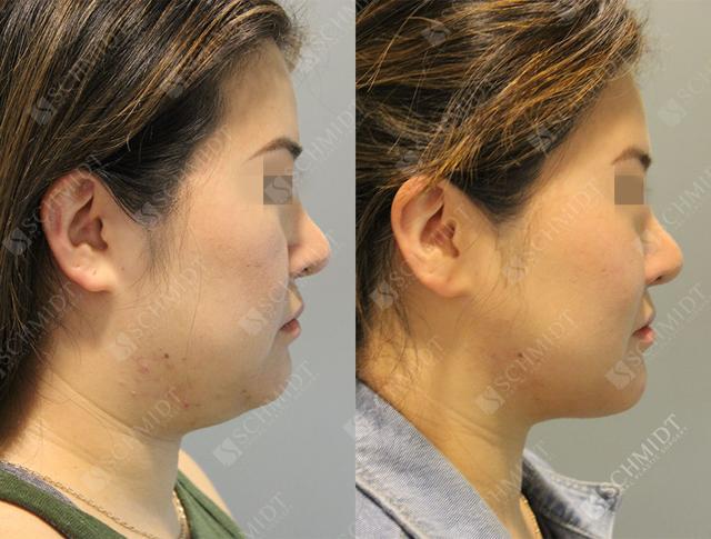 Liposuction result at Schmidt Plastic Surgery in Englewood, CO