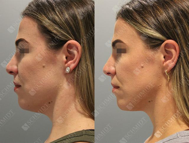 Liposuction result at Schmidt Plastic Surgery in Englewood, CO