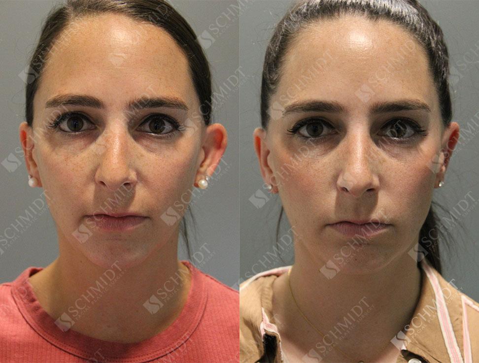 Schmidt Plastic Surgery otoplasty result — Englewood, CO