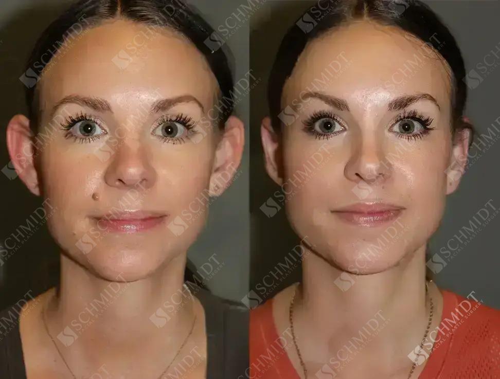 Schmidt Plastic Surgery otoplasty result — Englewood, CO