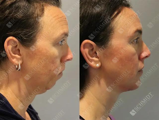 Chin Implant result at Schmidt Plastic Surgery in Englewood, CO