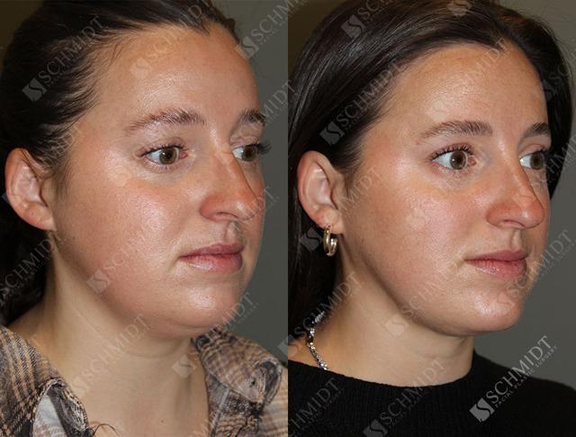 Neck Liposuction result at Schmidt Plastic Surgery in Englewood, CO