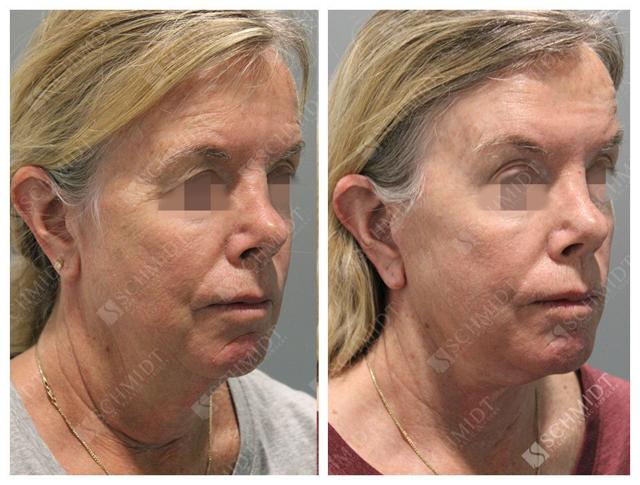 Brow Lift result at Schmidt Plastic Surgery in Englewood, CO
