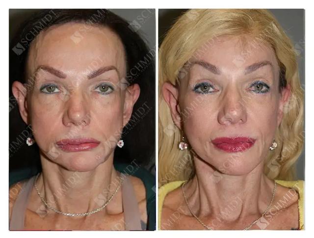 Blepharoplasty result at Schmidt Plastic Surgery in Englewood, CO