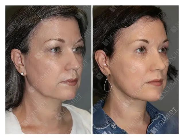 Facelift result at Schmidt Plastic Surgery in Englewood, CO
