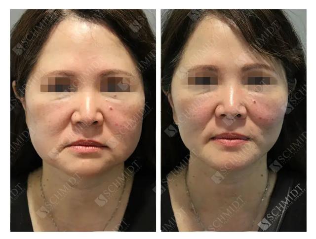 Deep Plane Facelift result at Schmidt Plastic Surgery in Englewood, CO