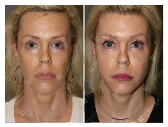 Brow Lift result at Schmidt Plastic Surgery in Englewood, CO