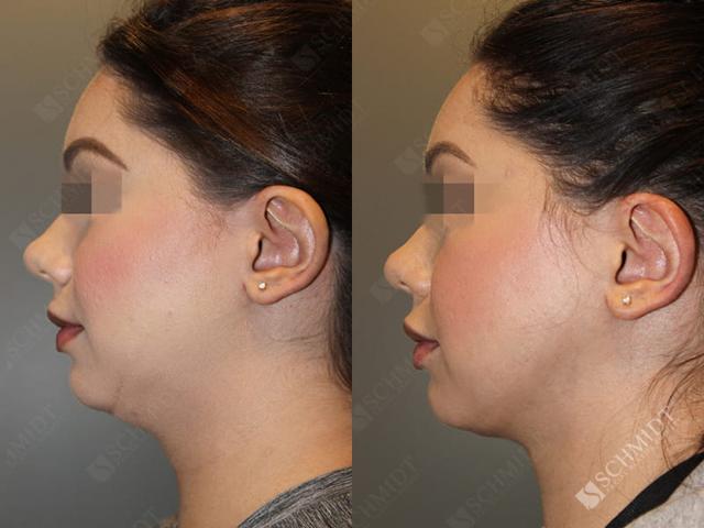 Liposuction result at Schmidt Plastic Surgery in Englewood, CO