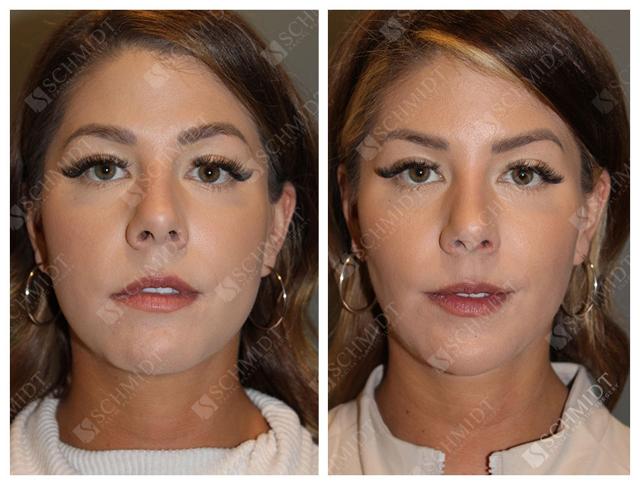 Functional Rhinoplasty result at Schmidt Plastic Surgery in Englewood, CO