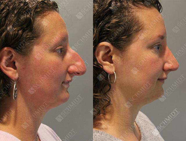 Rhinoplasty result at Schmidt Plastic Surgery in Englewood, CO