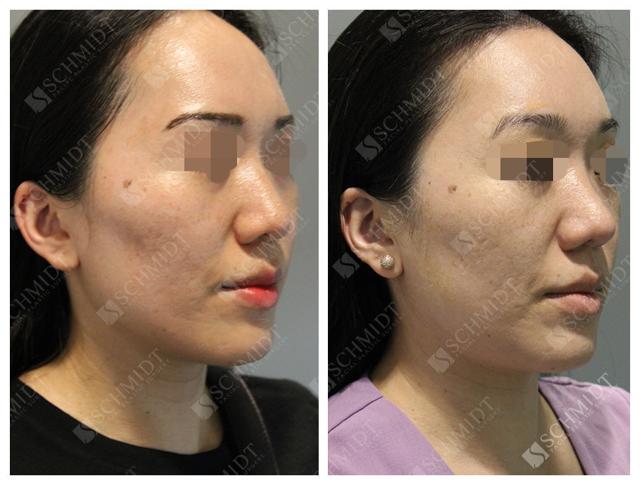 Brow Lift result at Schmidt Plastic Surgery in Englewood, CO