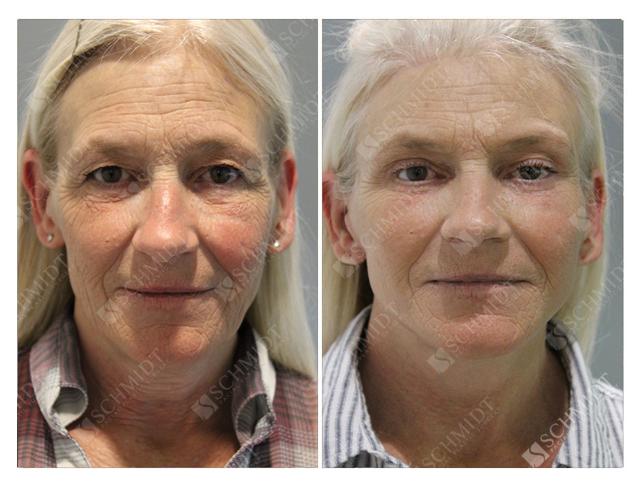 Facelift result at Schmidt Plastic Surgery in Englewood, CO
