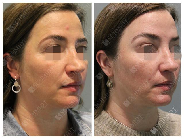 Brow Lift result at Schmidt Plastic Surgery in Englewood, CO