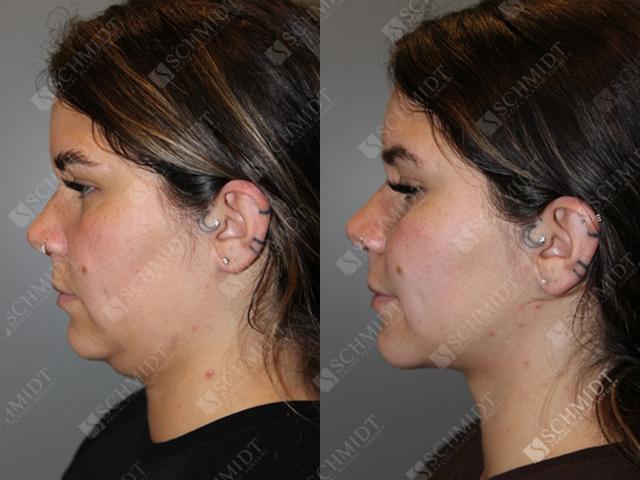Liposuction result at Schmidt Plastic Surgery in Englewood, CO